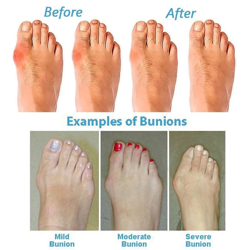 BunionRelief | Orthopedic Correcting Sandals